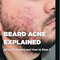 Beard Acne Explained: Why It Happens and How to Stop It