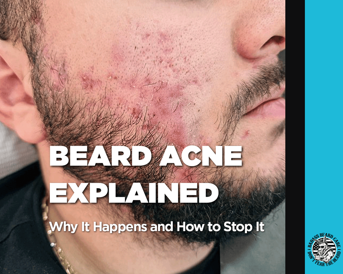 Man with beard and beard acne along his upper cheek line from his ears to his nose.